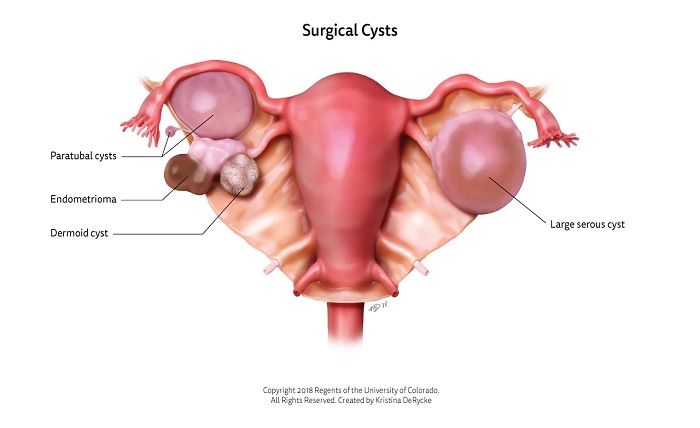 GYNECOLOGY
